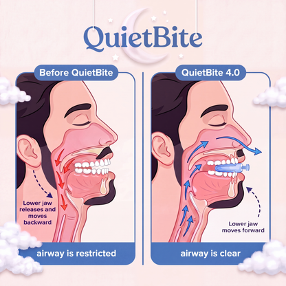 QuietBite 4.0™ Anti-Snoring Mouthpiece